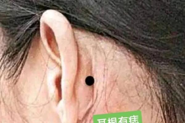 耳根脚下长痣痣相,耳朵根部有痣代表什么