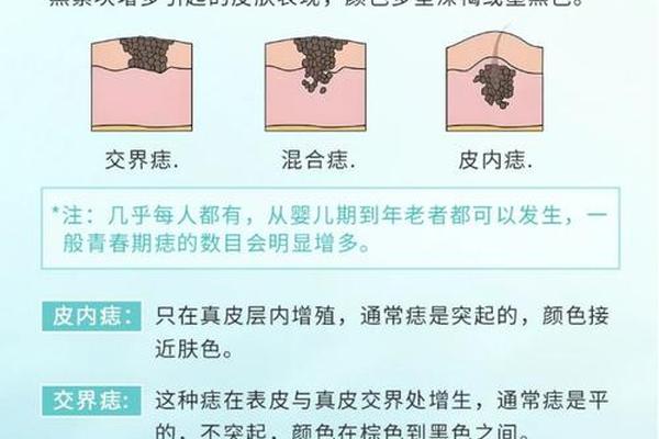 痣相色是什么意思啊图片—痣的颜色有几种图片 痣相色是什么意思啊图片—痣的颜色有几种图片