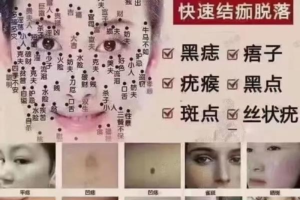 相医生祖传秘方祛痣祛斑;祛斑和祛痣是一样的吗