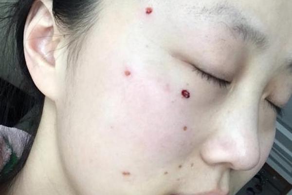 点痣有没有改相_点痣真的能改运吗