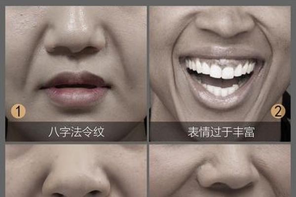 嘴角八字纹图片