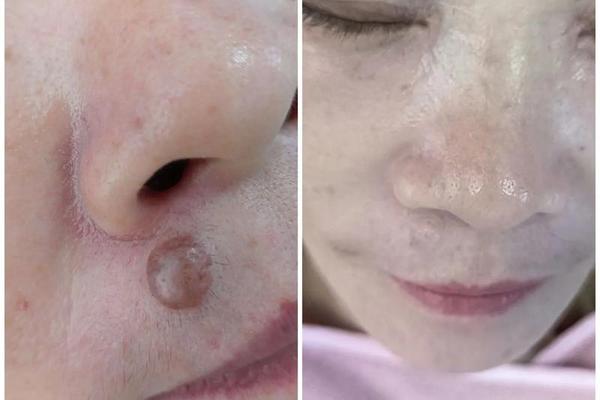 点痣还要看痣相吗图片大全;点痣后图片前后对比 点痣还要看痣相吗图片大全;点痣后图片前后对比