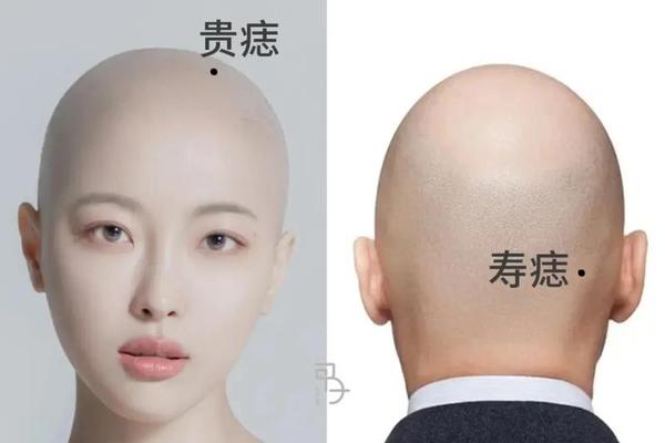女人头上痣相;头皮上有痣代表什么