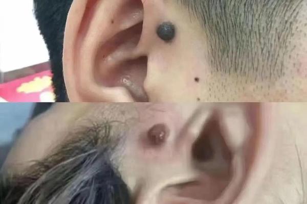 麻衣相耳垂前边有痣好不好_耳垂下有痣图解