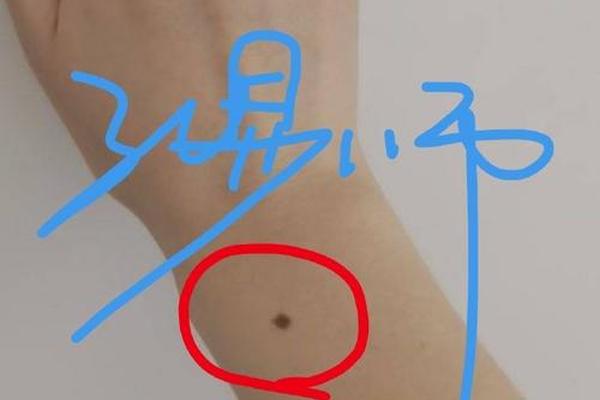 女性右手肘痣相、右手痣相