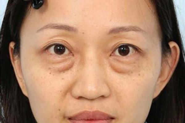 眼下八字纹