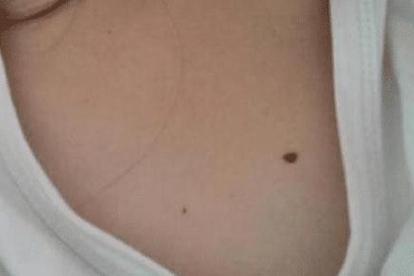 乳腺上方有痣相,恶性痣的图片