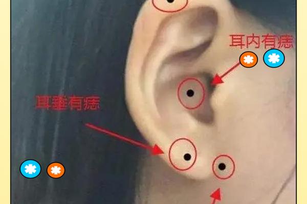 耳朵前面有痣官相(耳朵前面的痣代表什么)