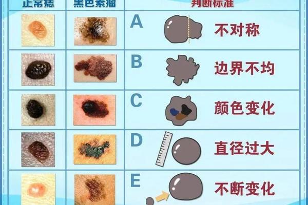 慢性病的痣相_不健康的痣是什么样子