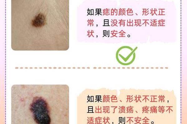 脸上长痣有毛是吉相吗,脸上有痣长毛意味着什么