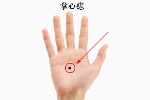 女人左手掌心有痣相_女生左手掌心突然长了一颗痣