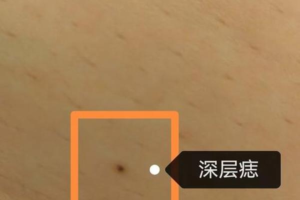 观相女人被点痣视频播放 自己在家怎么点痣视频