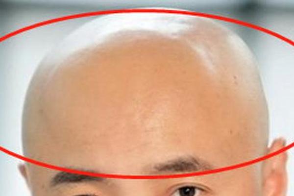 伏羲痣相—方形伏羲骨面相