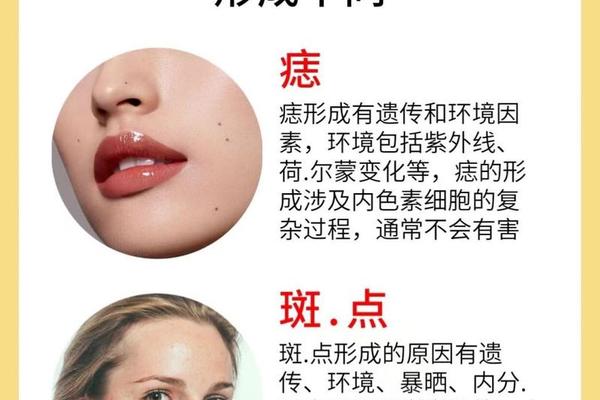 痣相等同于斑相么、斑和痣的区别图片