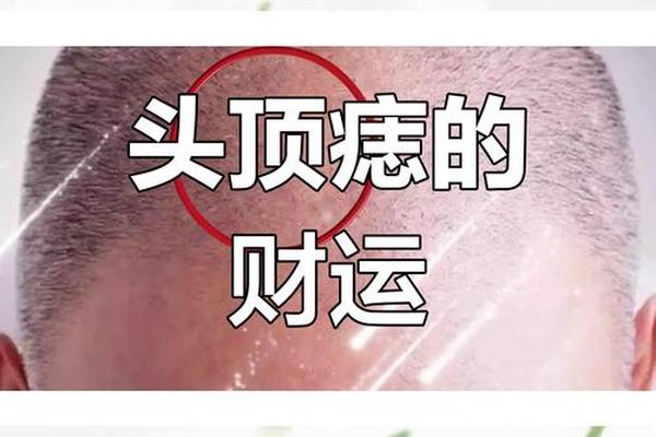 麻衣神相头皮长痣_痣长在头皮上有什么说法