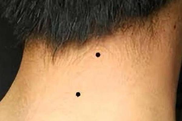男人左脖子痣相—左边长痣的男人命运