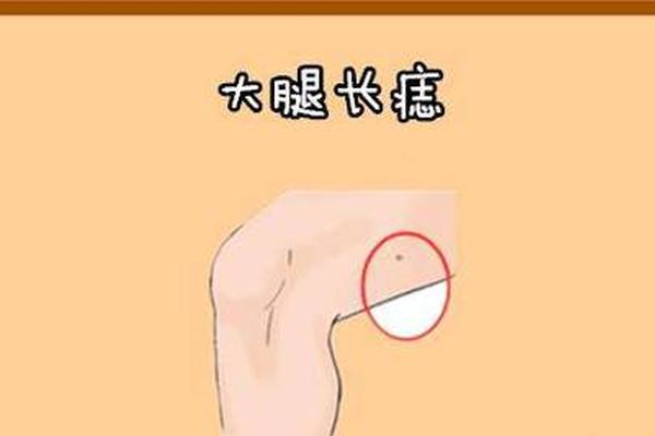 麻衣神相大腿内侧有痣,大腿内侧巨富痣