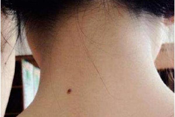 后劲痣相;男生后脖子中间有痣