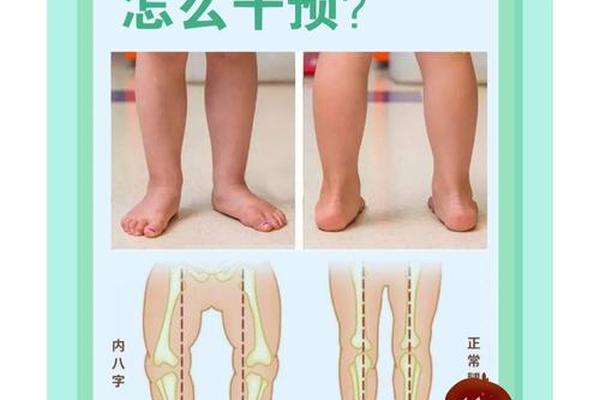 八字脚如何矫正