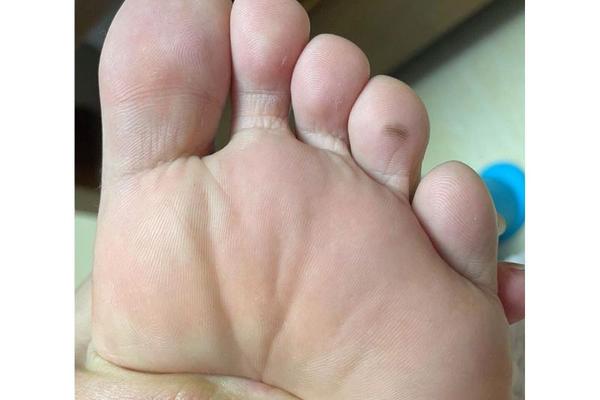 脚相第二根脚趾长痣-右脚二脚趾有痣