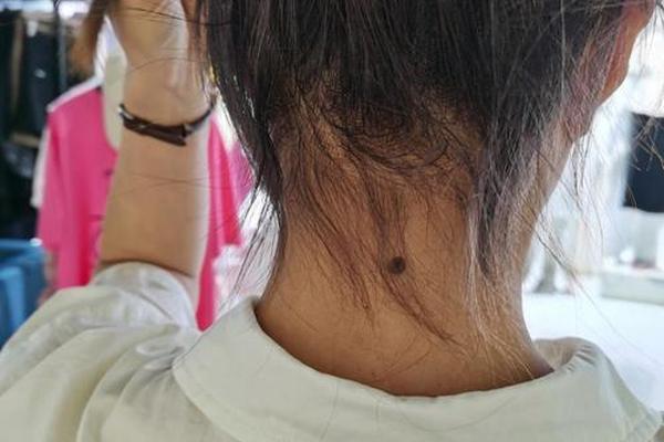 后脖子的痣相 脖子后面有颗大痣