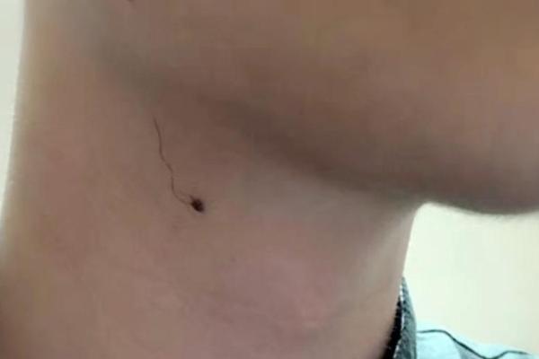 男人脖子左前边痣相,男人左侧脖子长痣而且有毛