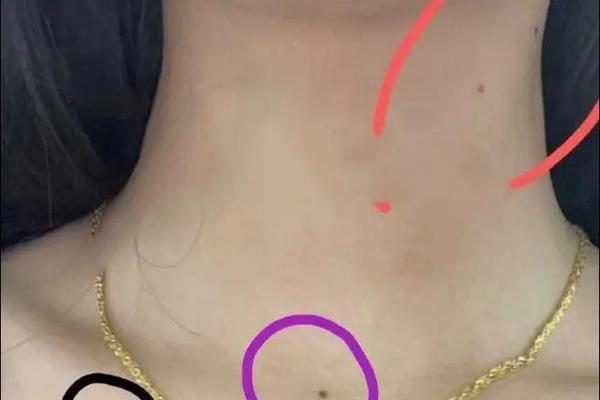 痣相锁骨痣;锁骨痣的位置与命运的关系 痣相锁骨痣;锁骨痣的位置与命运的关系