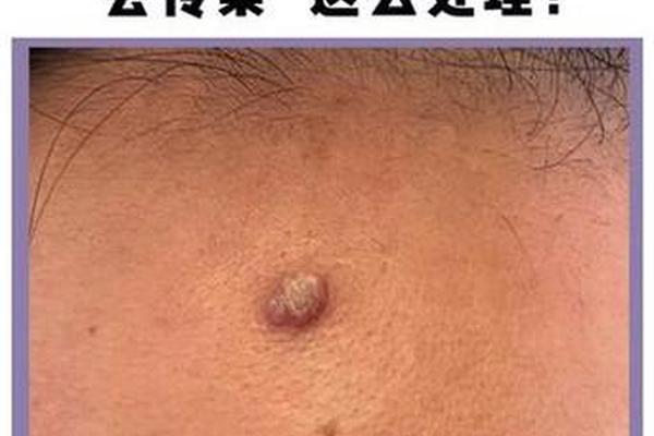 痣相花、像菜花一样的痣是什么