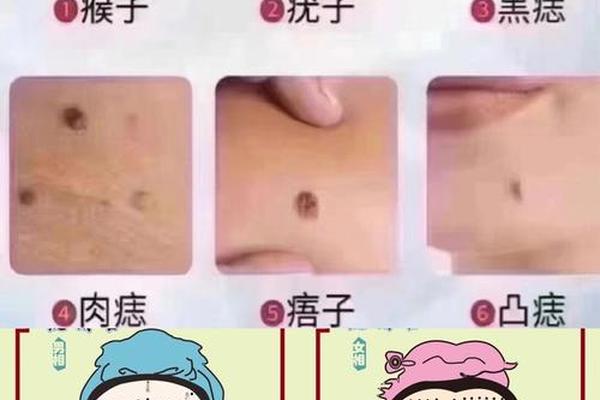 痣与痦 相区别—瘊和痣的区别图片