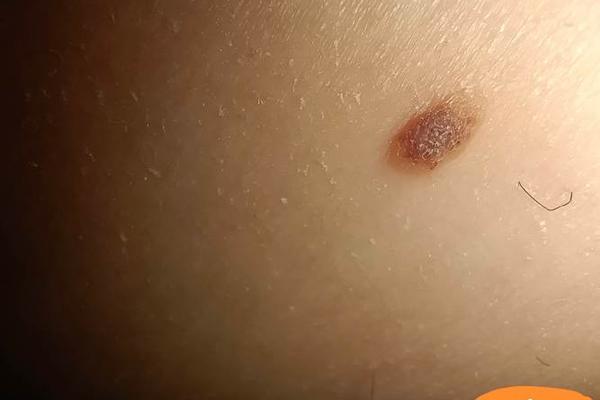 大腿上痣相,长在大腿上左有痣代表什么图解 大腿上痣相,长在大腿上左有痣代表什么图解