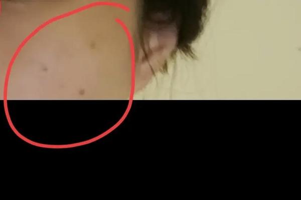 观相师三颗痣好不好看—鼻梁有三颗痣三角形