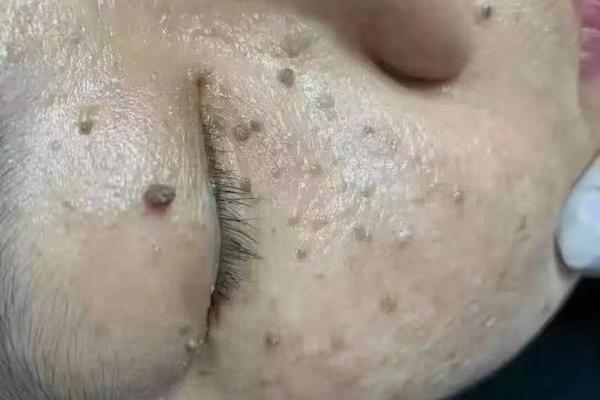 和皮肤相平的痣,脸上与皮肤一样平的痣怎么去