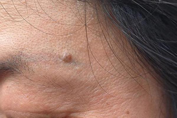 眉毛上一颗痣相小肉瘤—眉毛上长了个肉瘤