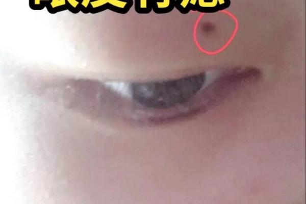 面部田宅痣相_面部太田痣图片