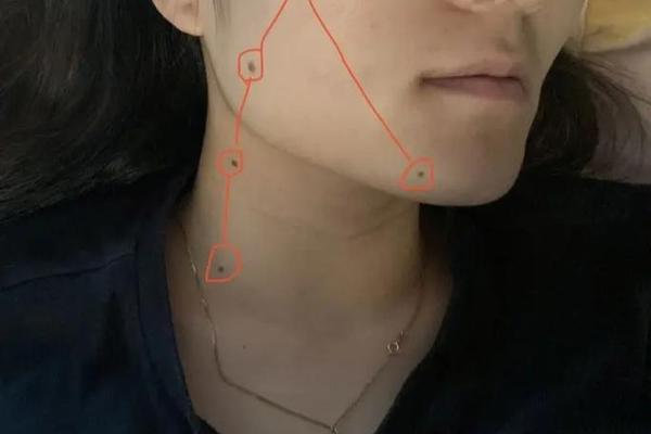 七星痣是吉相还是凶相呢 七星痣一般在什么地方