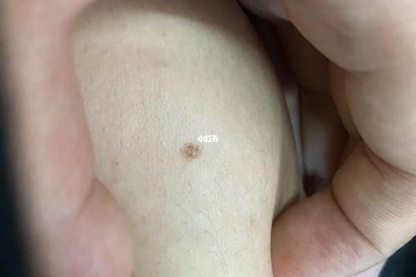 肚子上的痣相_肚子右侧有痣代表什么意思