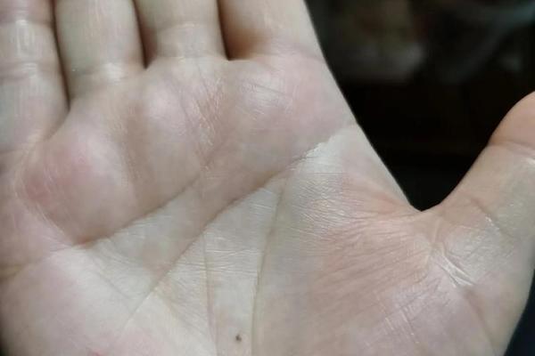 手掌有红痣相(手掌红痣的位置和命运)