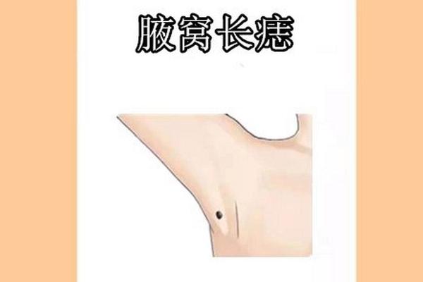 腋窝处的痣痣相—女人痣相图解 腋窝处的痣痣相—女人痣相图解