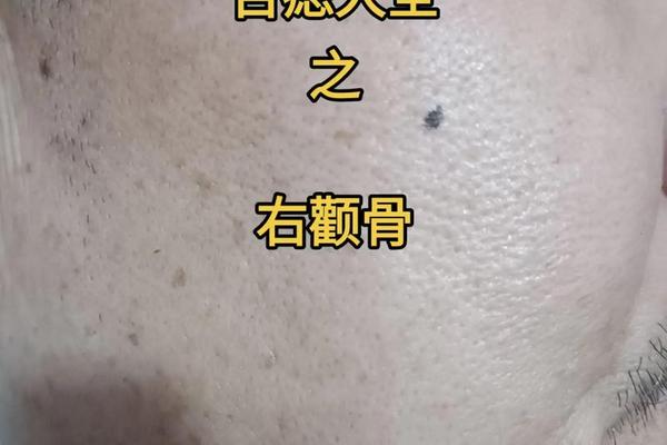 女人颧骨痣相最准图—颧骨有痣的女人面相图解