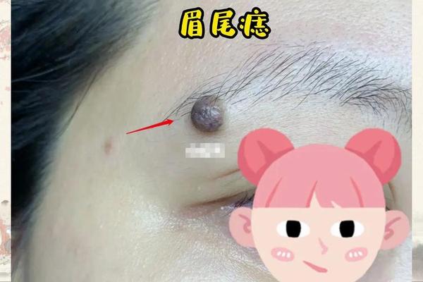 眉毛尾上面痣相女 眉毛尾有痣女人好吗 眉毛尾上面痣相女 眉毛尾有痣女人好吗