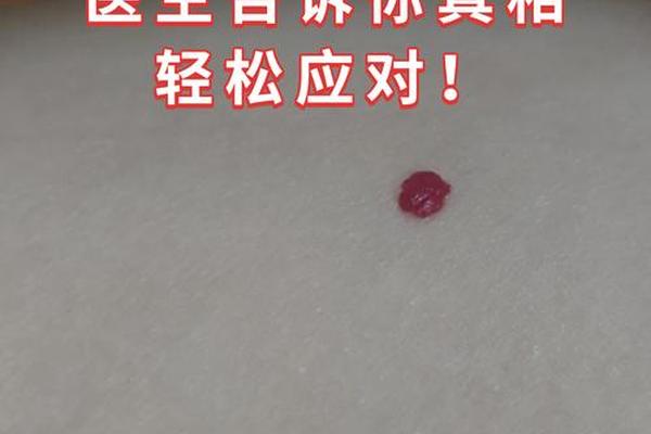 黑痣与红痣相法区别,正常红痣的图片