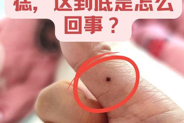 右手痣相男、右手突然长痣是什么意思