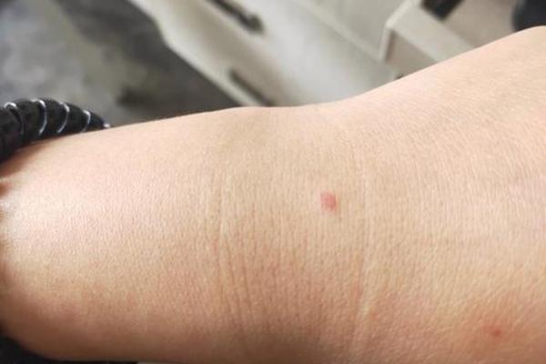 手上长了个相痣红点;身上长痣一样的红点是什么原因