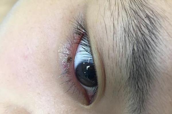 眼角旁边的痣相有痣好吗(眼角旁边的痣是什么痣) 眼角旁边的痣相有痣好吗(眼角旁边的痣是什么痣)
