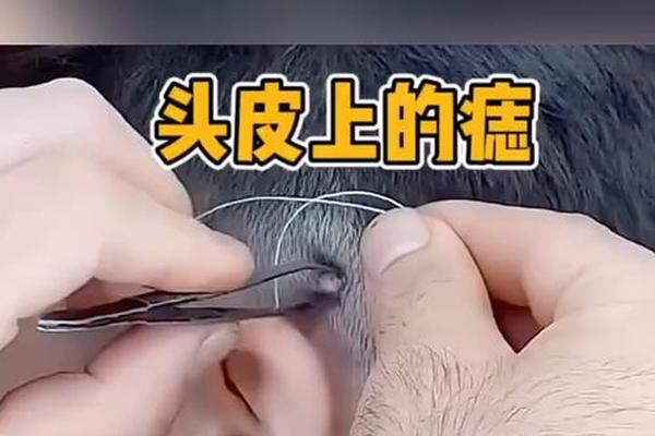 女人头顶痣相(头顶有颗痣)