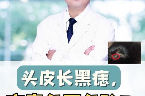 痣相头顶痣;头顶有痣的位置与命运图解