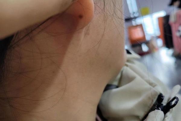 痣相女人耳朵后面—耳朵后面长痣代表什么女