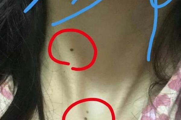 刹痣相;脖子前面的刹痣