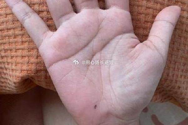 月丘痣相-月丘有痣
