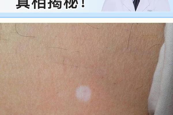 白痣相(白色痣是好痣吗)